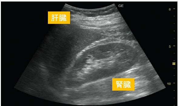 腹部エコー 正常な肝臓と腎臓