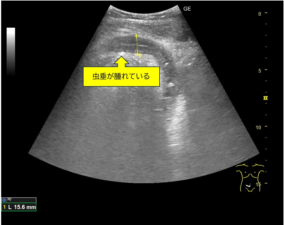 症例：急性虫垂炎
