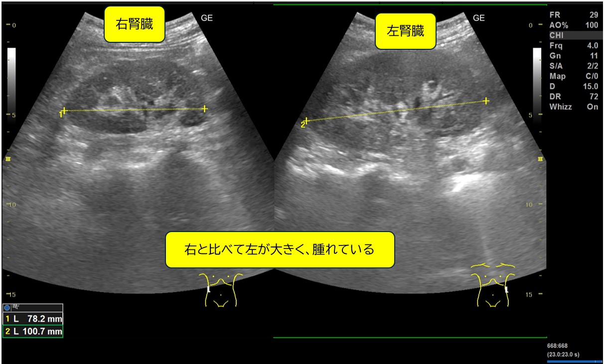 症例：腎盂腎炎
