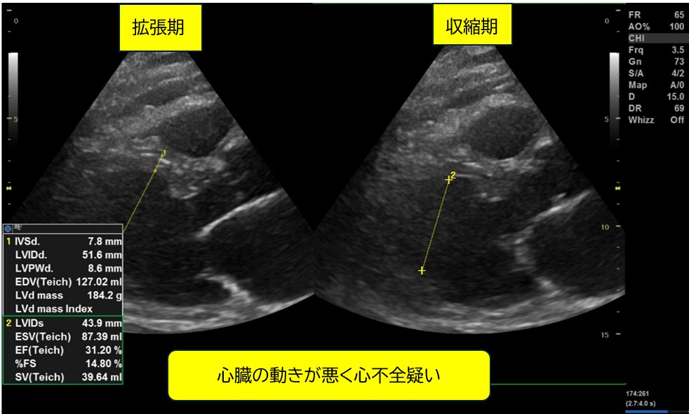 症例：心不全